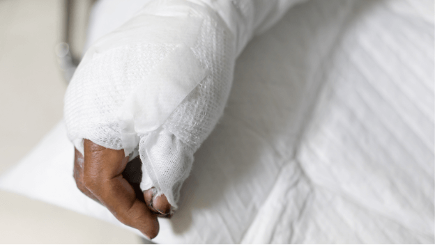 How does a burn injury lawsuit work?